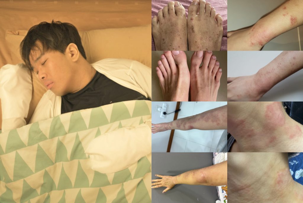 eczema mitten before after